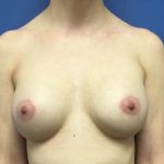 Breast Augmentation Before & After Patient #388