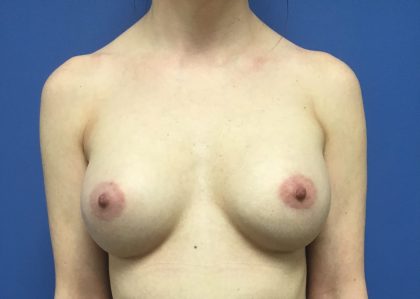Breast Augmentation Before & After Patient #388