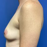 Breast Augmentation Before & After Patient #388