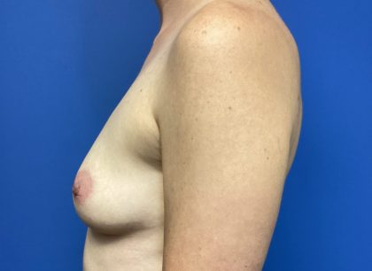 Breast Augmentation Before & After Patient #388