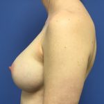 Breast Augmentation Before & After Patient #388