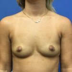 Breast Augmentation Before & After Patient #393