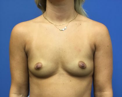 Breast Augmentation Before & After Patient #393
