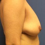 Breast Augmentation Before & After Patient #398