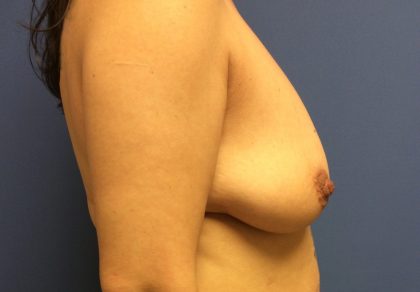 Breast Augmentation Before & After Patient #398