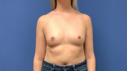 Breast Augmentation Before & After Patient #403