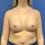 Breast Augmentation Before & After Patient #403