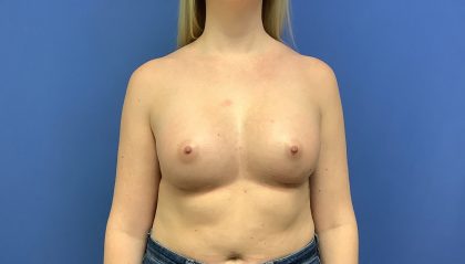 Breast Augmentation Before & After Patient #403