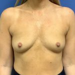 Breast Augmentation Before & After Patient #408