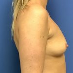 Breast Augmentation Before & After Patient #408