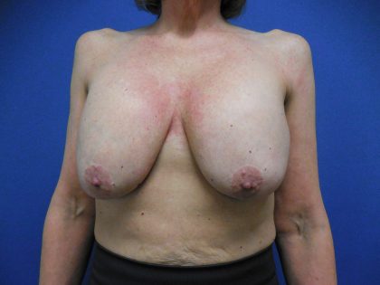 Breast Augmentation Before & After Patient #413