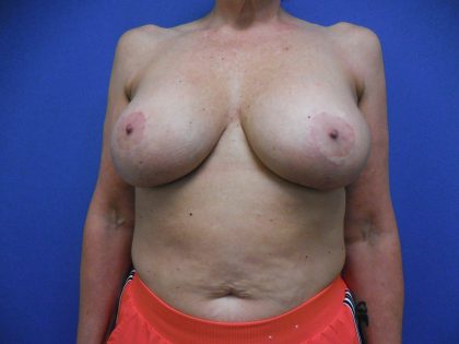 Breast Augmentation Before & After Patient #413