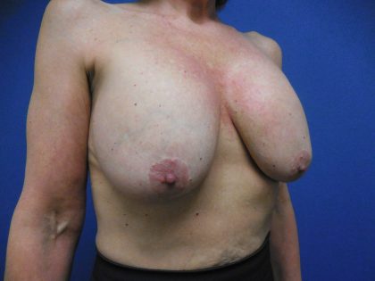 Breast Augmentation Before & After Patient #413