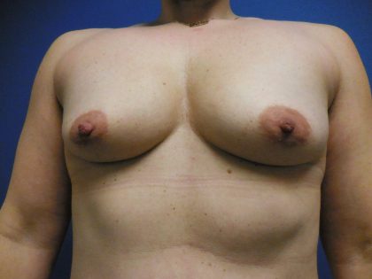 Breast Augmentation Before & After Patient #423
