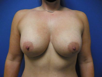 Breast Augmentation Before & After Patient #423