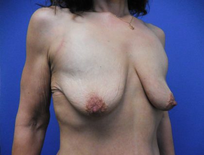 Breast Augmentation Before & After Patient #428