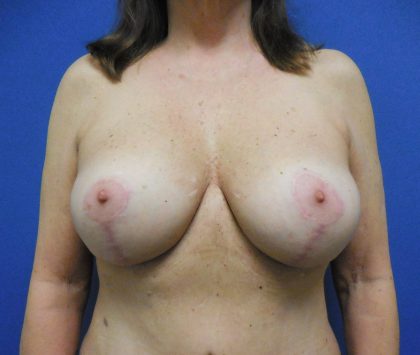 Breast Augmentation Before & After Patient #448