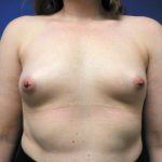 Breast Augmentation Before & After Patient #453