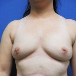 Breast Augmentation Before & After Patient #458