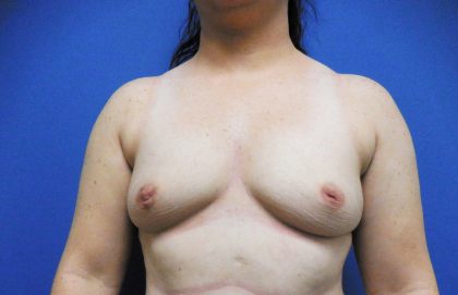Breast Augmentation Before & After Patient #458