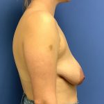 Breast Augmentation Before & After Patient #468
