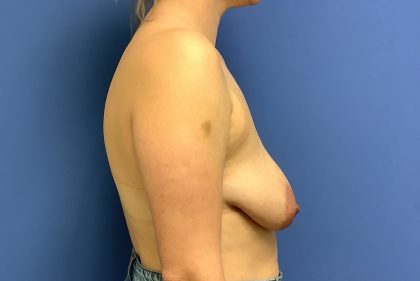 Breast Augmentation Before & After Patient #468