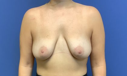 Breast Augmentation Before & After Patient #473