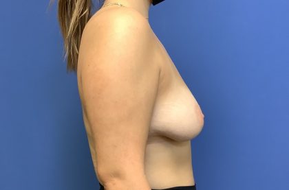 Breast Augmentation Before & After Patient #473