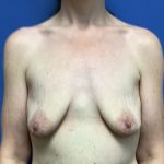 Breast Augmentation Before & After Patient #478