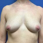 Breast Augmentation Before & After Patient #483