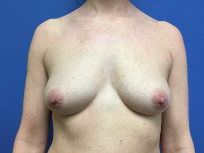 Breast Augmentation Before & After Patient #483