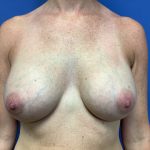 Breast Augmentation Before & After Patient #483