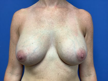 Breast Augmentation Before & After Patient #483