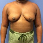 Breast Augmentation Before & After Patient #488