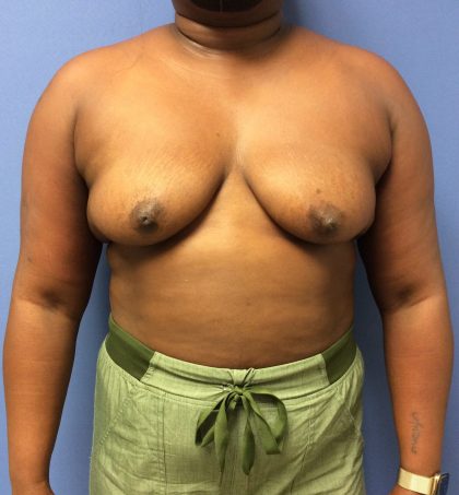 Breast Augmentation Before & After Patient #488