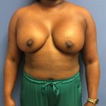 Breast Augmentation Before & After Patient #488