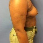 Breast Augmentation Before & After Patient #488