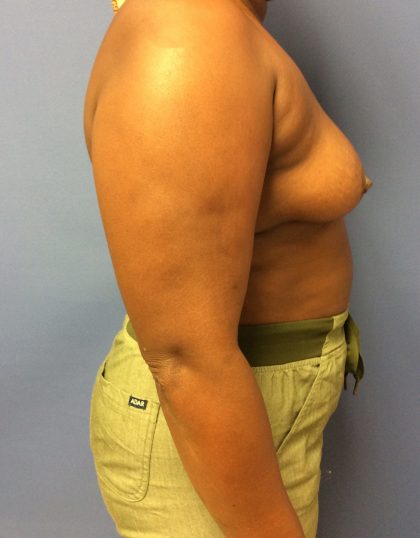 Breast Augmentation Before & After Patient #488