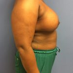 Breast Augmentation Before & After Patient #488
