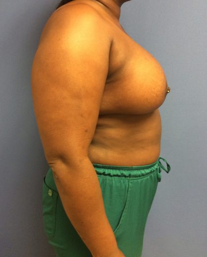 Breast Augmentation Before & After Patient #488