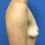 Breast Augmentation Before & After Patient #493