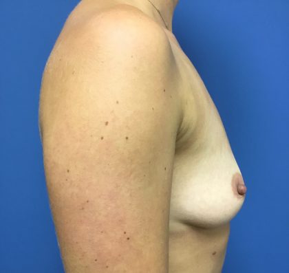Breast Augmentation Before & After Patient #493