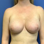 Breast Augmentation Before & After Patient #498
