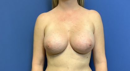 Breast Augmentation Before & After Patient #498