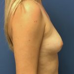 Breast Augmentation Before & After Patient #498