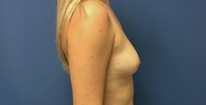 Breast Augmentation Before & After Patient #498