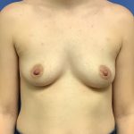 Breast Augmentation Before & After Patient #503