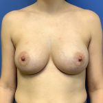 Breast Augmentation Before & After Patient #503