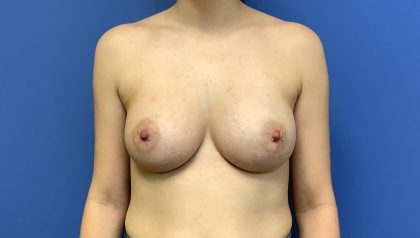 Breast Augmentation Before & After Patient #503