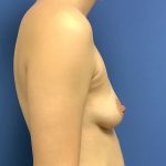 Breast Augmentation Before & After Patient #503